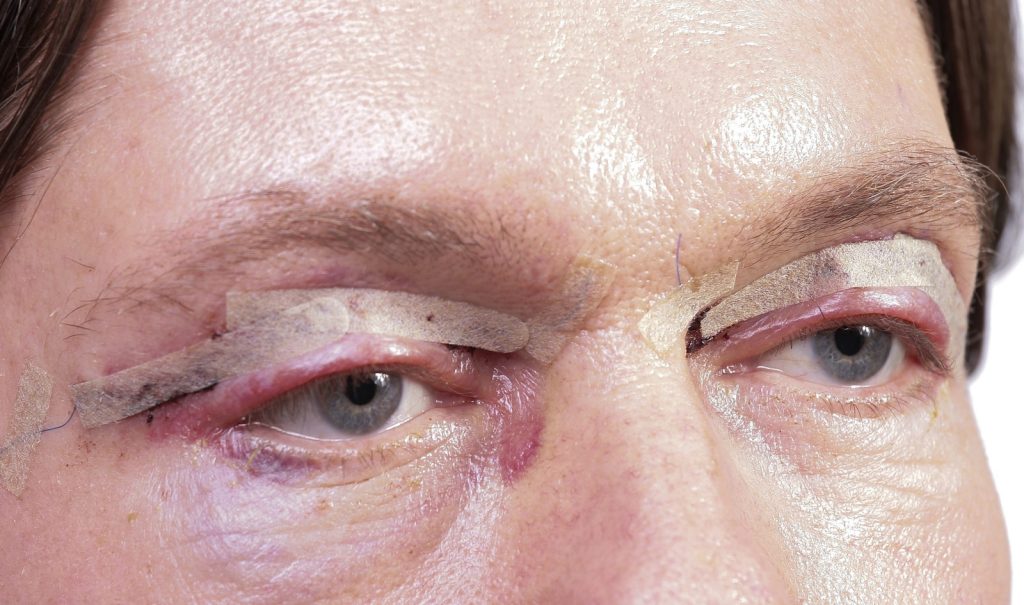 Cosmetic Surgery Claim