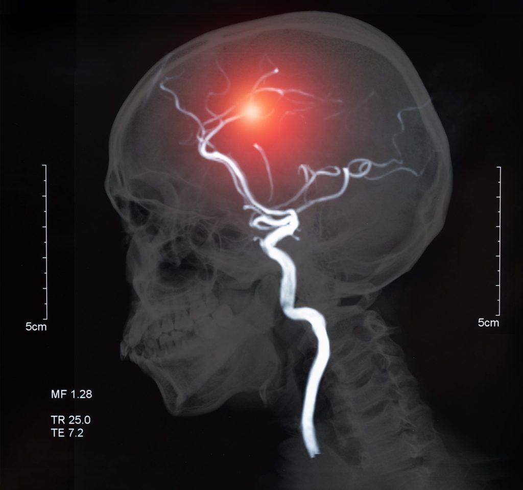 Brain Injury
