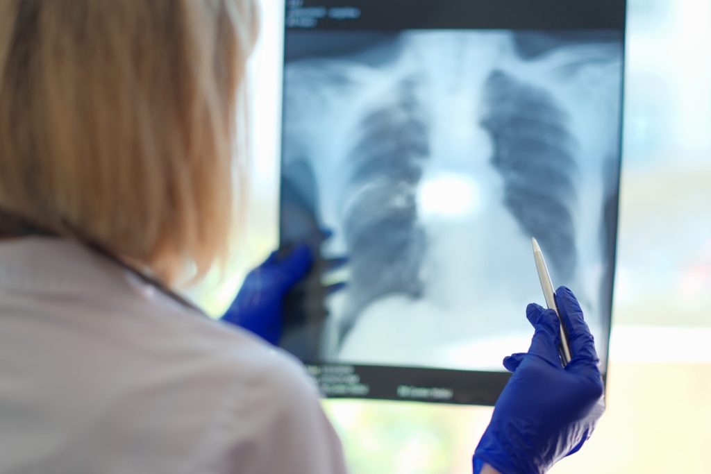 Mesothelioma Claims