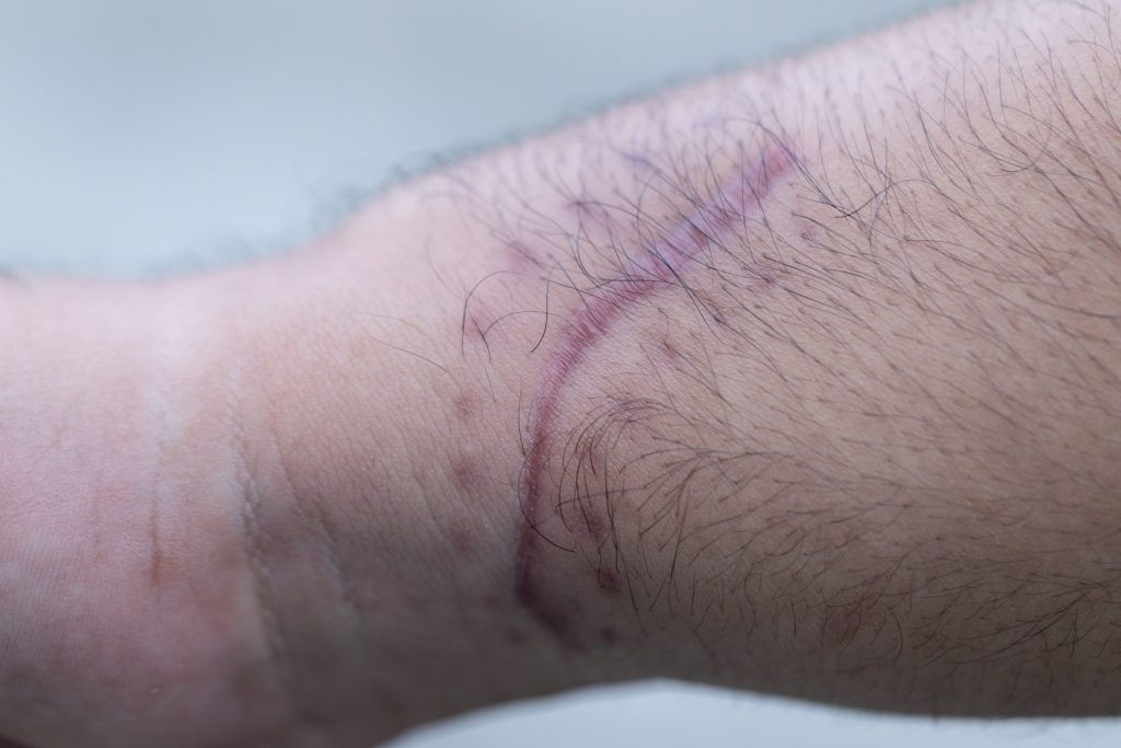 Scarring Claim