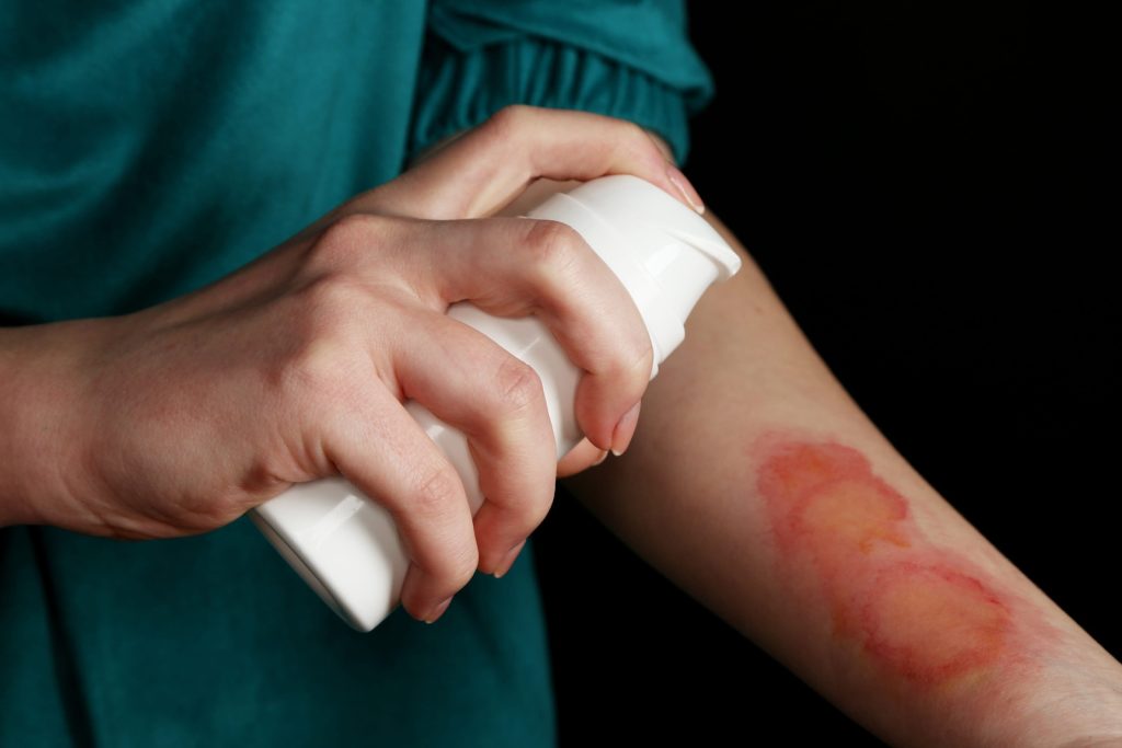 Burn Injury Claims