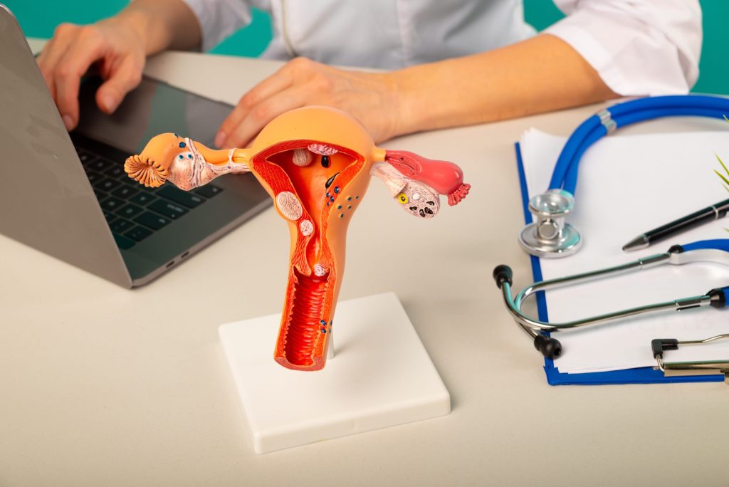 Ovarian Cancer Misdiagnosis