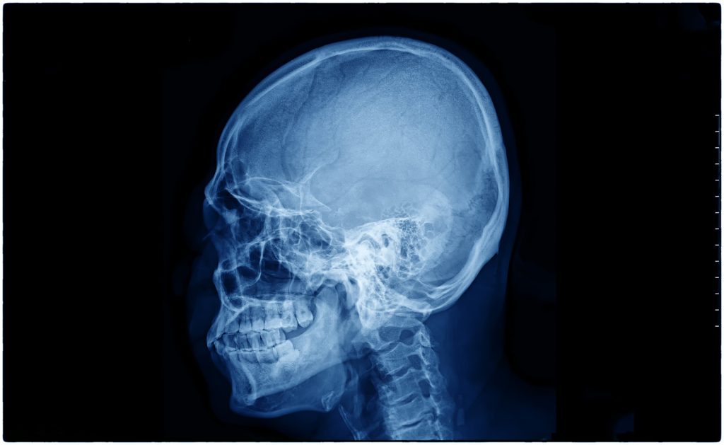 Concussion Injury Claim