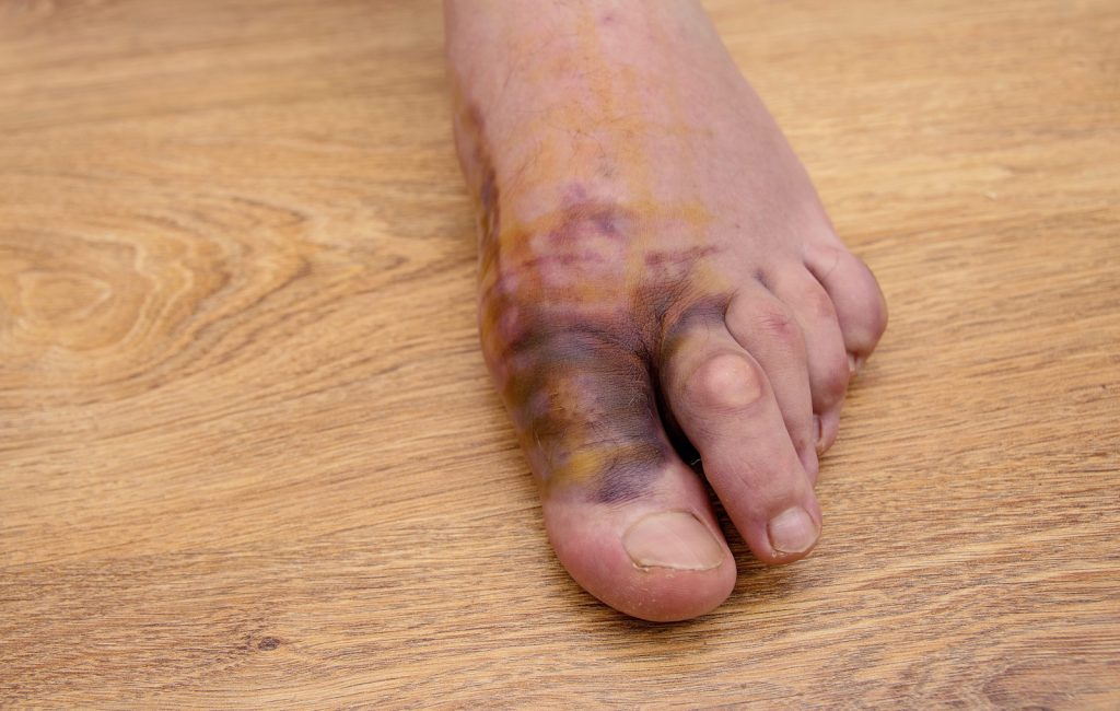Foot Injury Claim