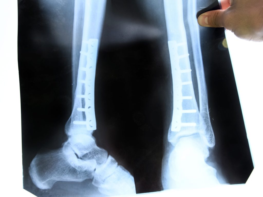 Fractured Bone