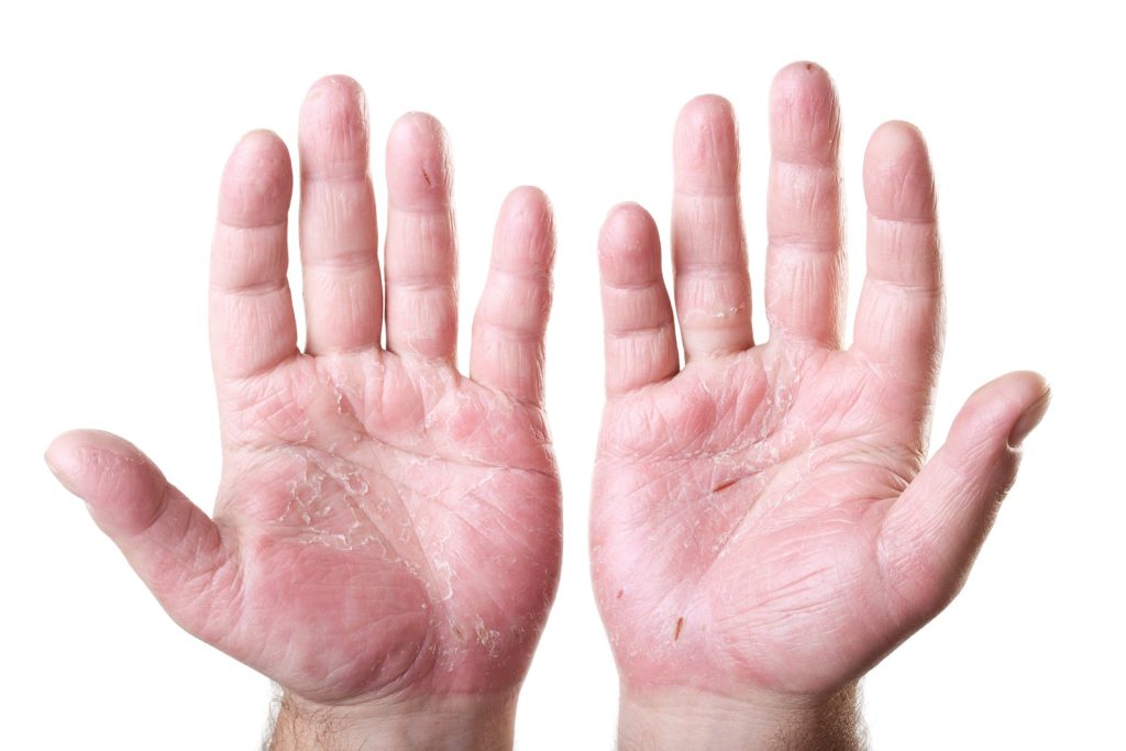 Occupational Dermatitis