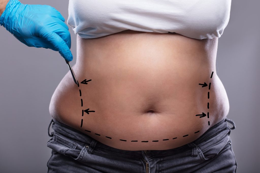Liposuction Negligence
