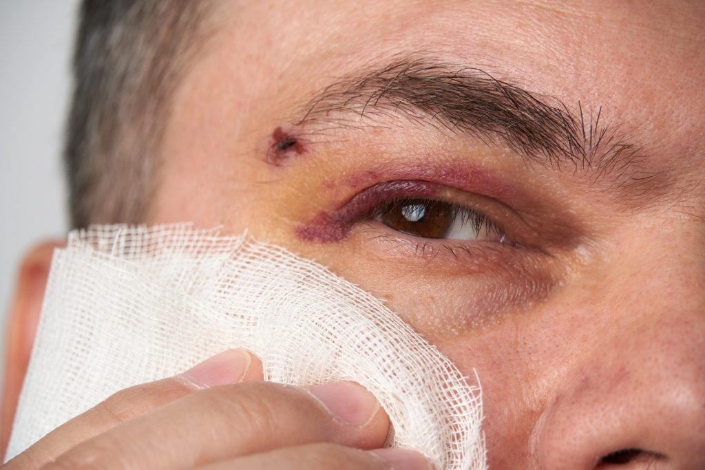 Eye Injury At Work