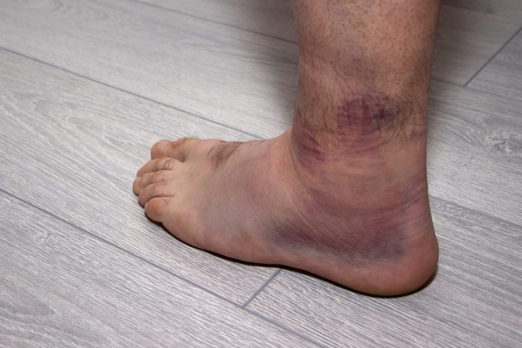 Sprained Ankle Treatment