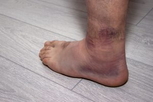 Sprained Ankle Treatment