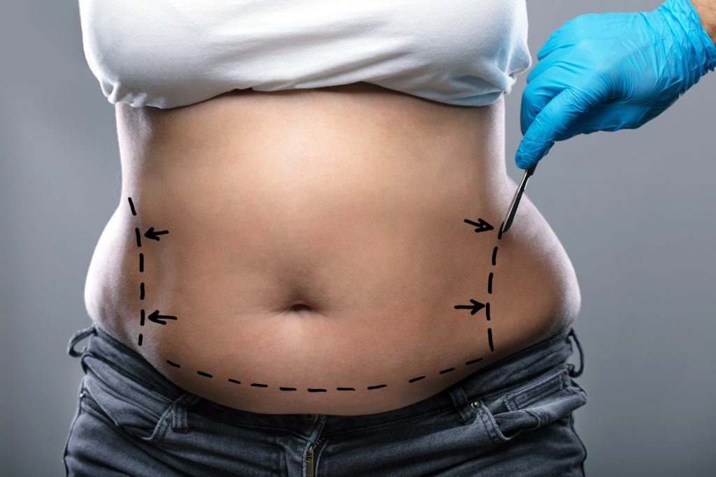 Tummy Tuck Claims