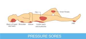 Pressure Sores