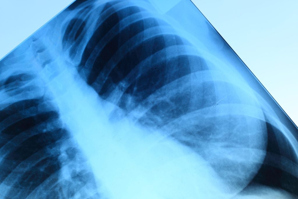 Chest Injury Claim