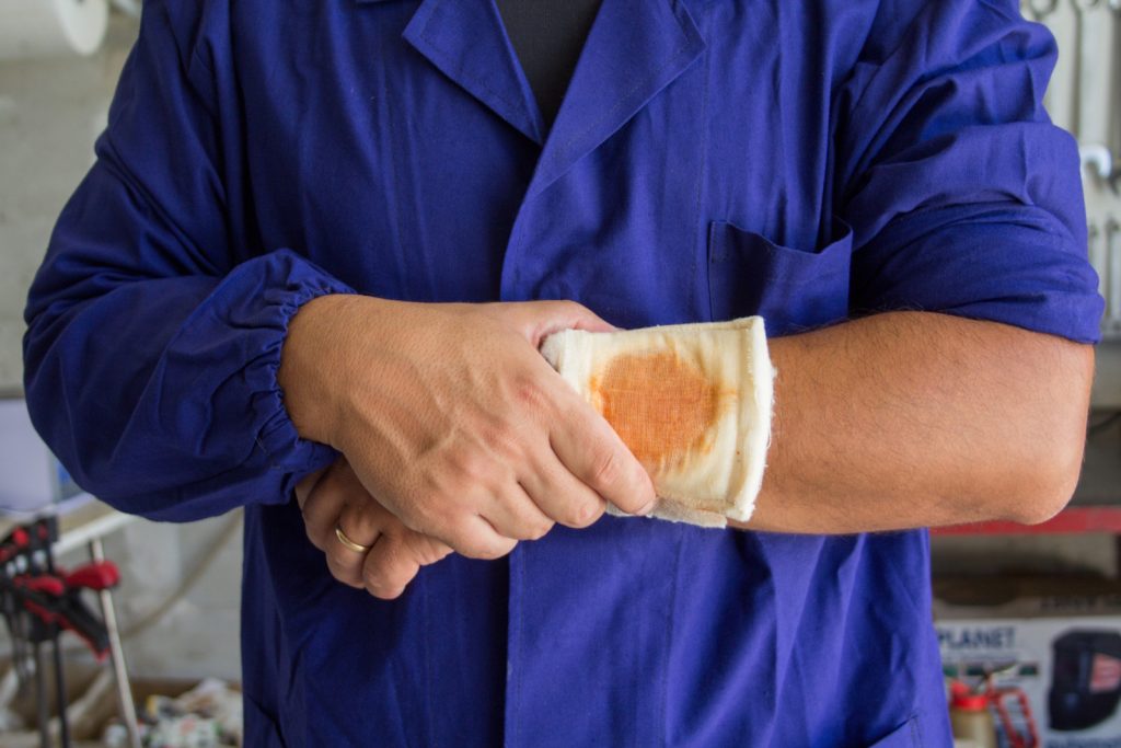 Chemical Burns Claim