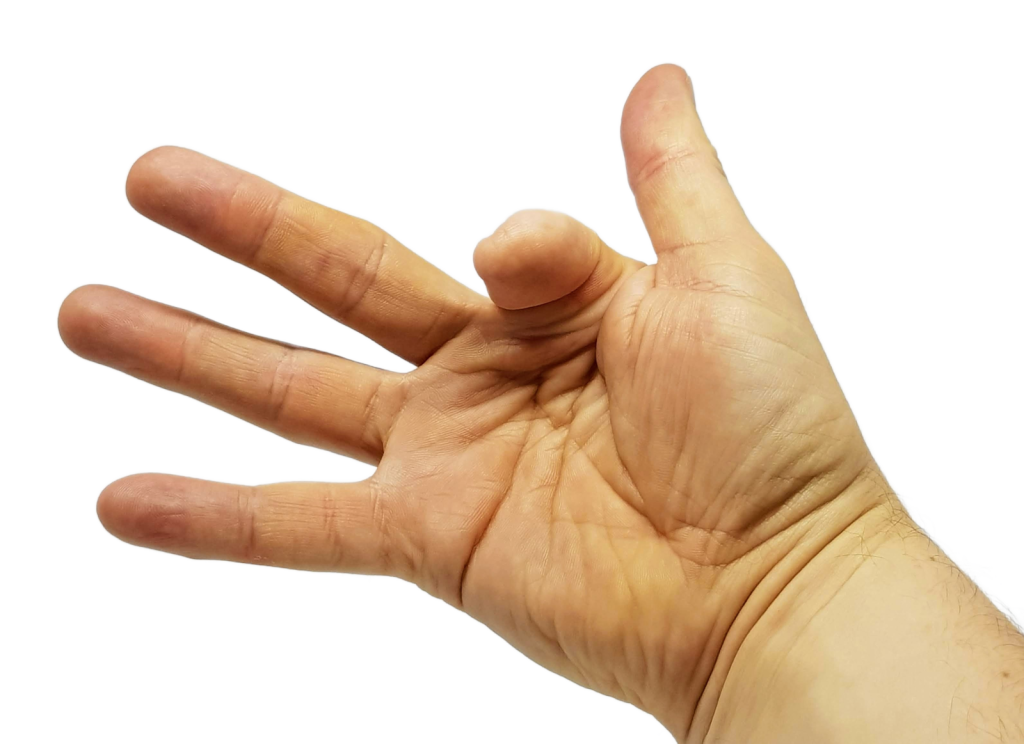 Finger Amputation