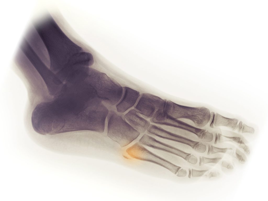 Avulsion Fracture
