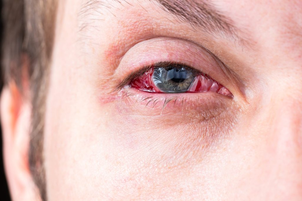 Eye Injury At Work