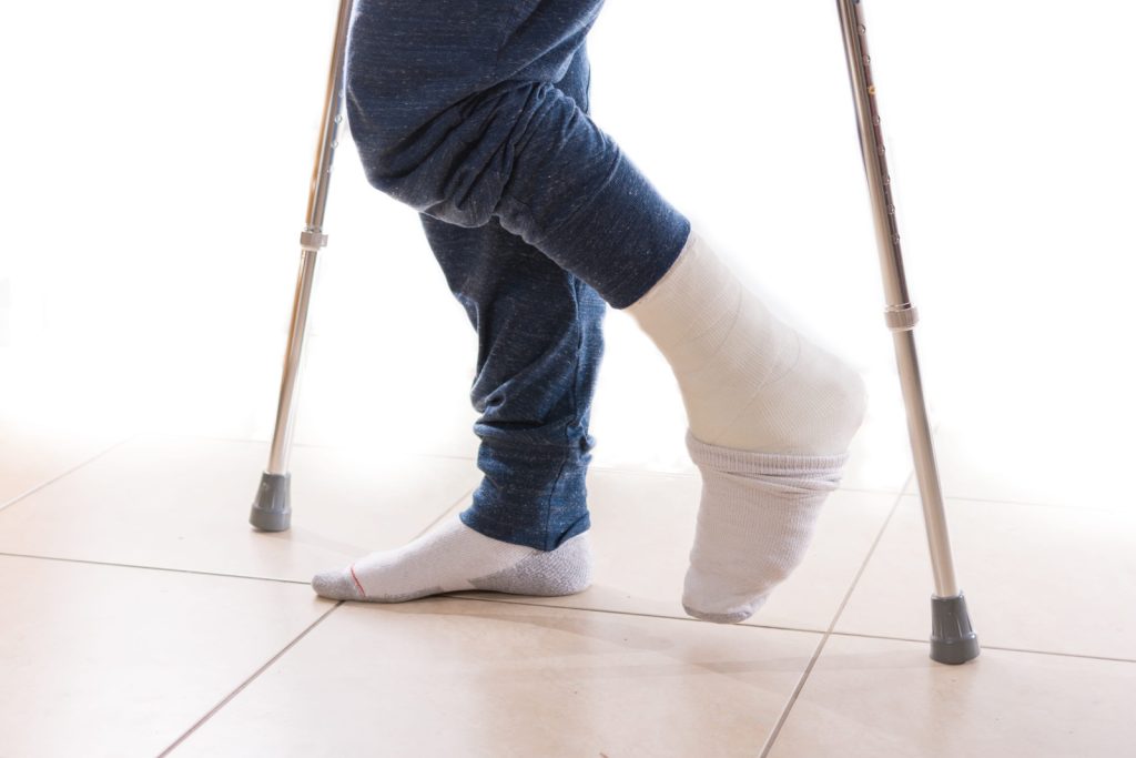 Broken Ankle