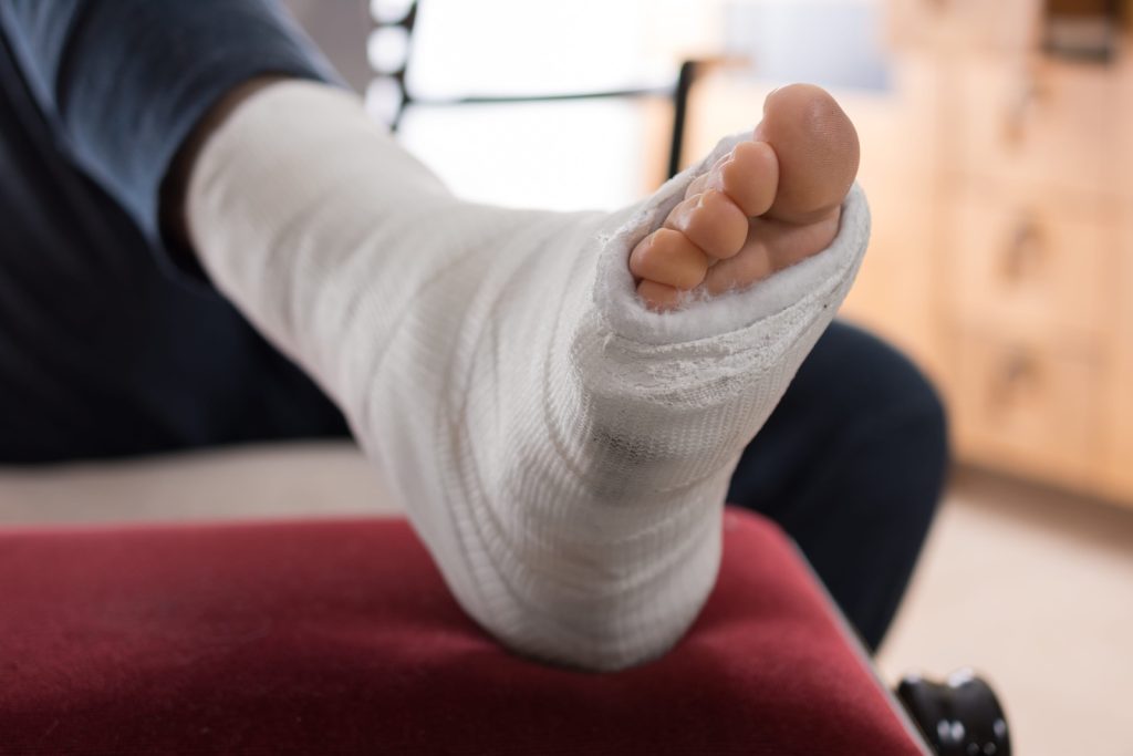 Broken Foot
