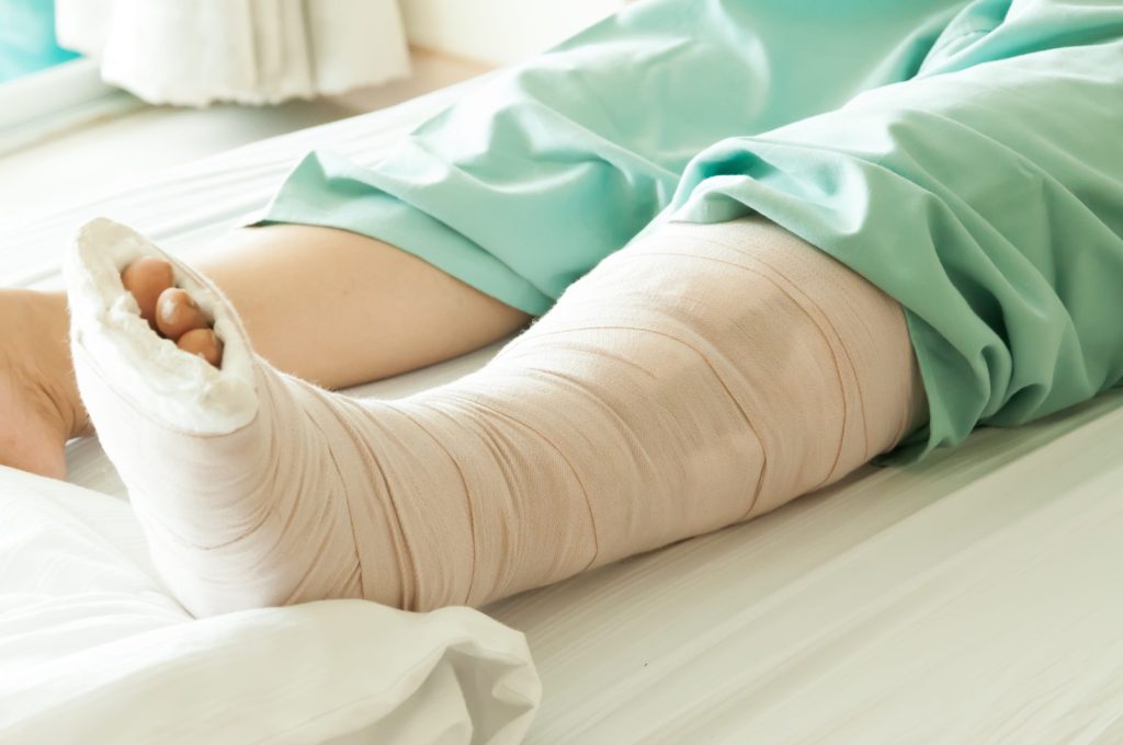 Broken Leg