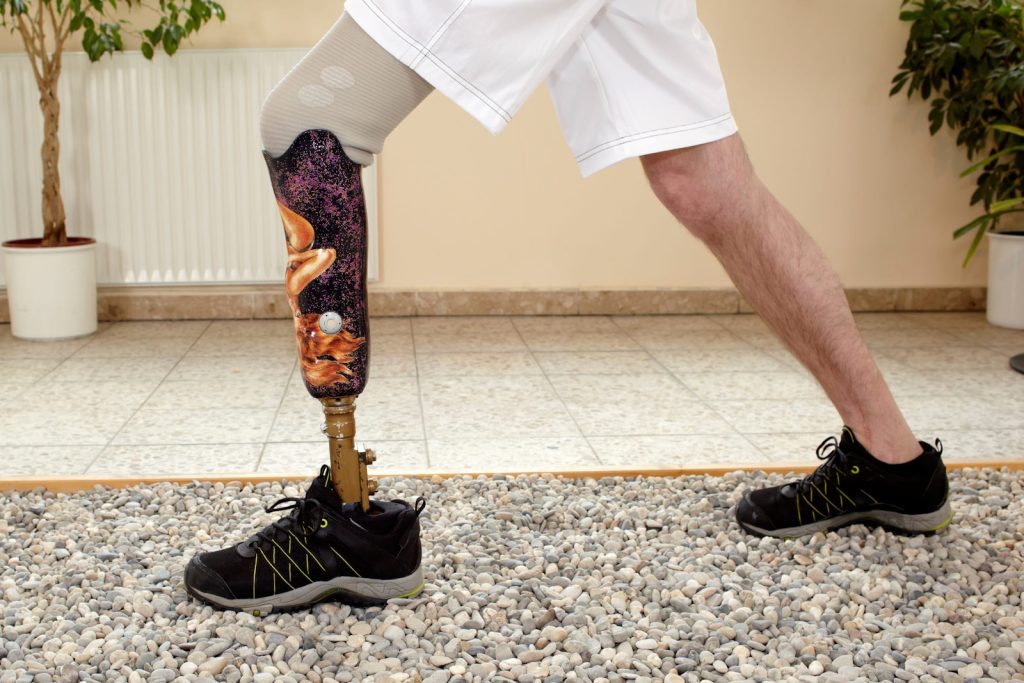 Loss Of Limb