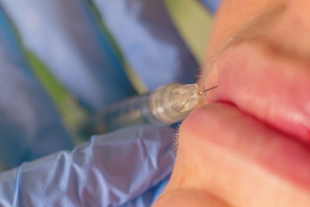 Nerve Damage From Lip Injections