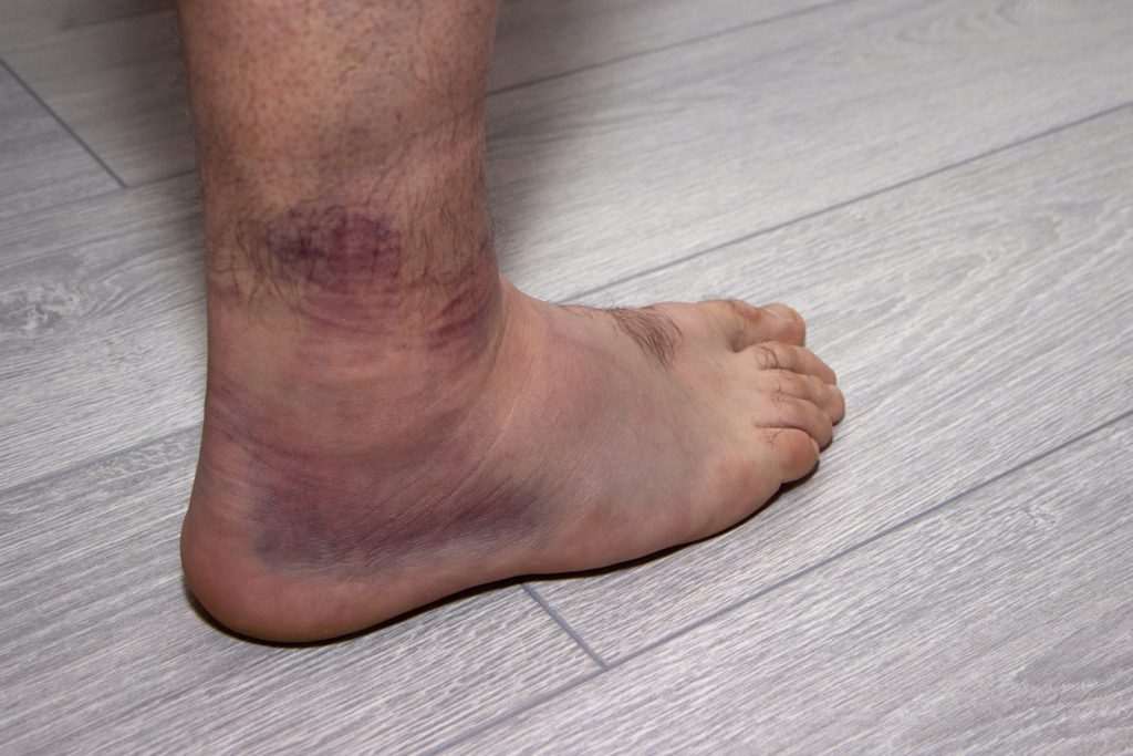 Sprained Ankle