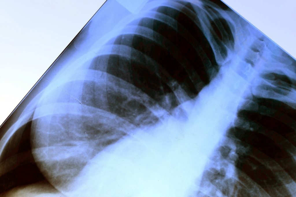 Fractured Sternum