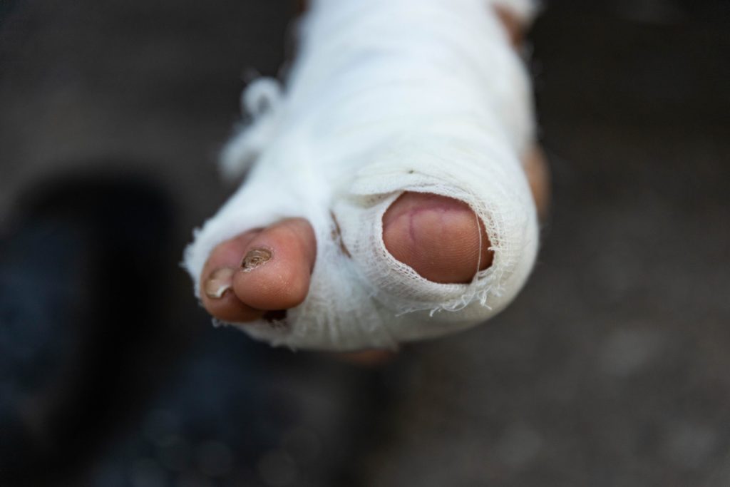 Loss Of A Toe