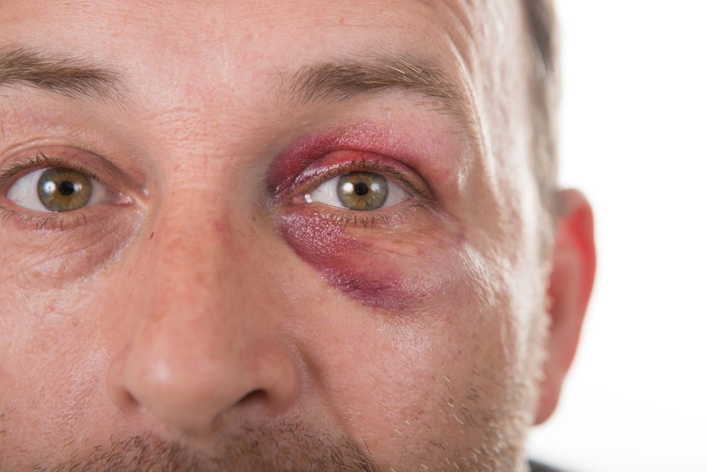 Fractured Eye Socket