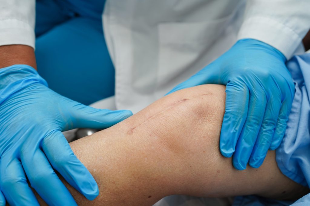 Knee Replacement Surgery Scar