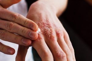 Skin Condition Claim