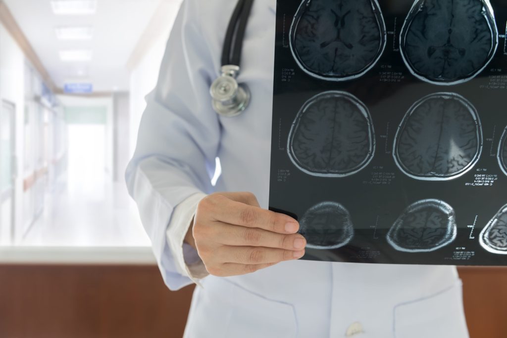 Stroke Misdiagnosis Claim